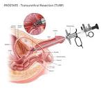 https://www.urologyhealth.org/urology-a-z/b/benign-prostatic-hyperplasia-(bph)/surgery